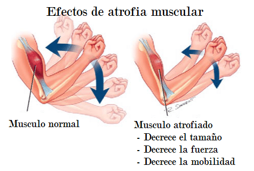 Atrofia muscular - Fit Soul