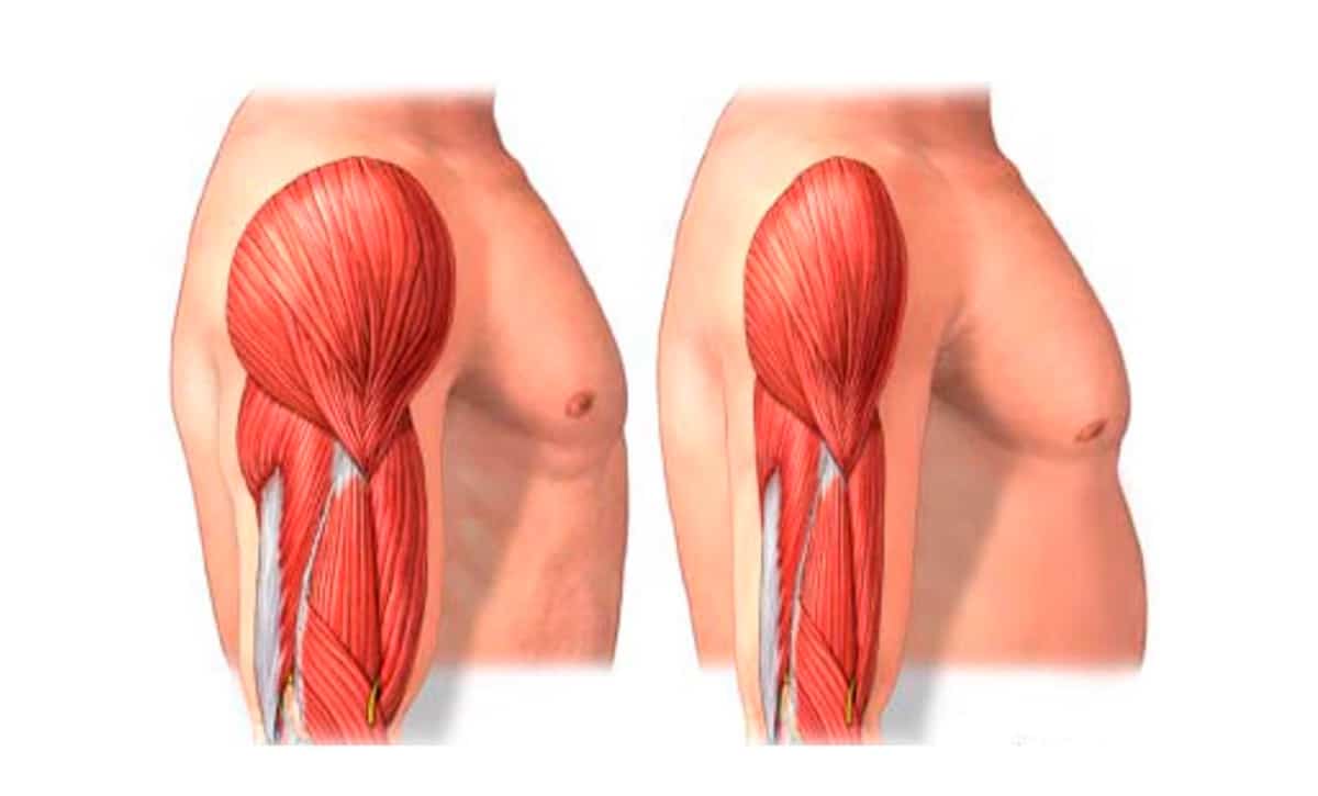Perdida Muscular Qué enfermedades causan pérdida de masa muscular - Fit Soul