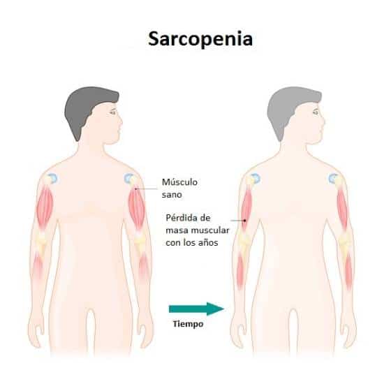 Sarcopenia - Enfermedades que ocasionan la pérdida de masa muscular
